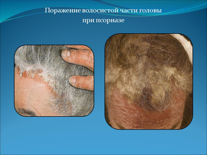 Поражение волосистой части головы  при псориазе